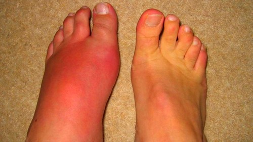 a láb köszvényének természetes kezelése coxarthrosis csípőízületek kezelési áttekintése